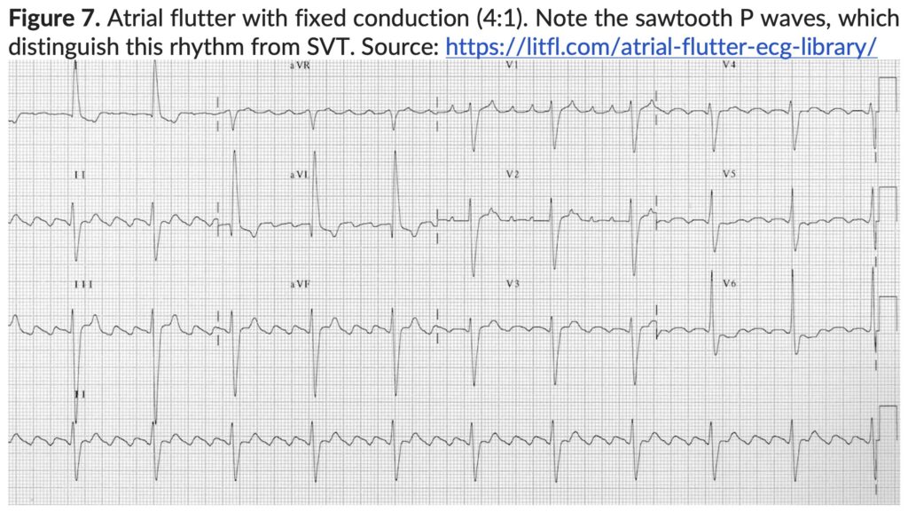 Figure 7. Atrial Flutter with fixed conduction.